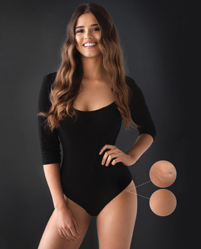 Cellfina Treatment
