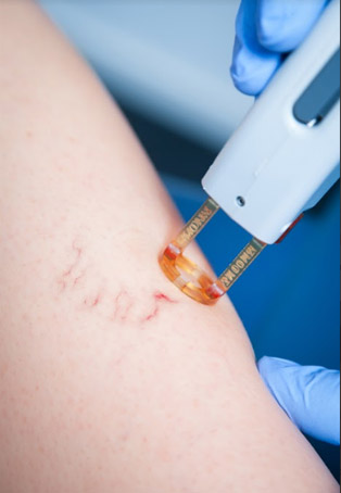 VARICOSE AND SPIDER VEINS SCLEROTHERAPY TREATMENT at La Boussole