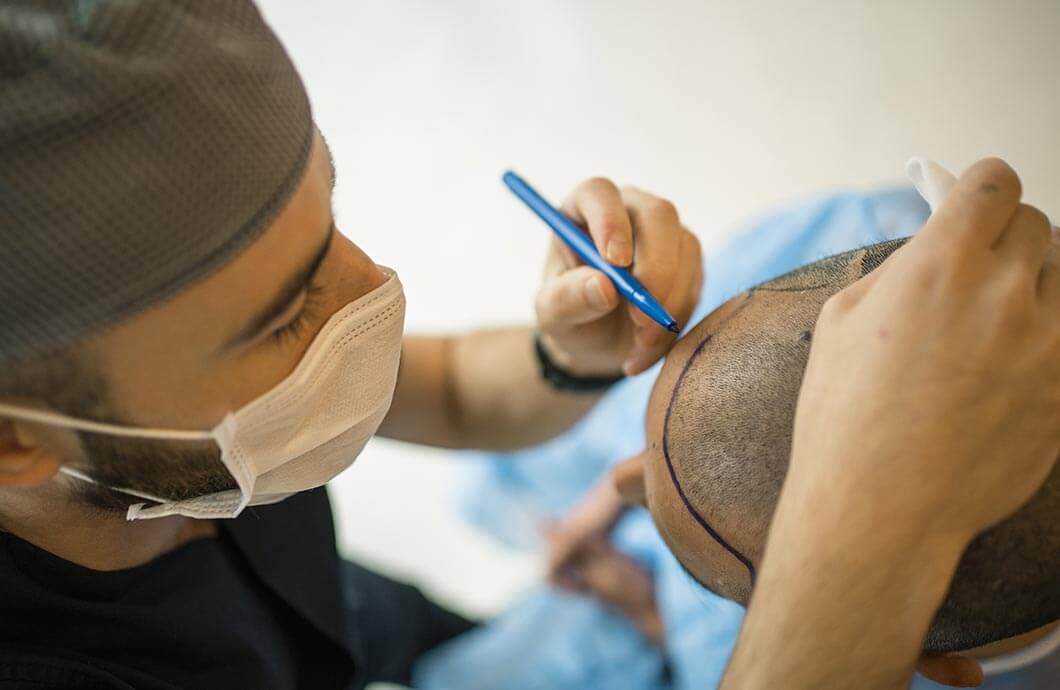 Hair Transplant