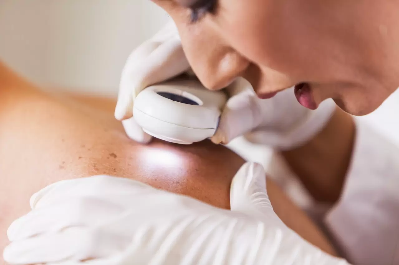 Skin Lesion & Mole Removal | Laser Skin Tag Removal