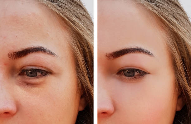 what causes eye bags