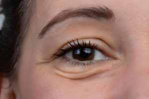 how to reduce eye bags