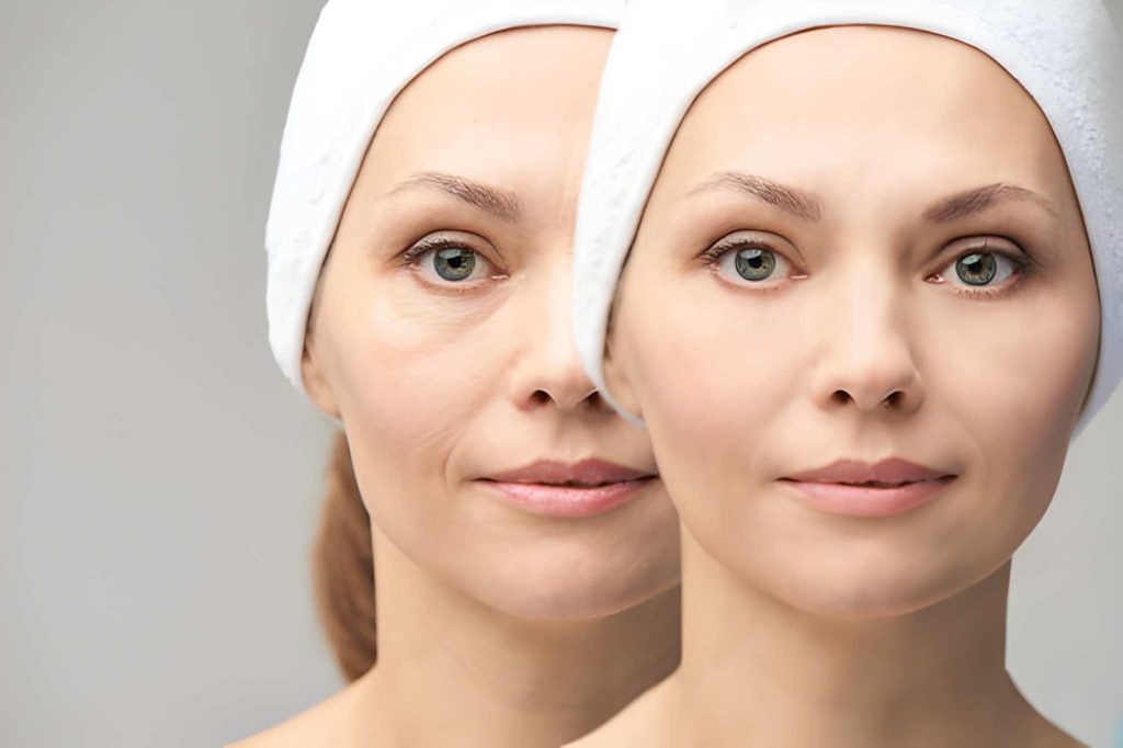 how to get rid of puffy eyes naturally