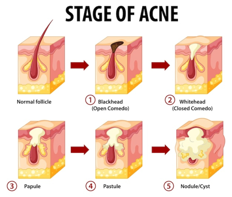 how to treat closed comedones