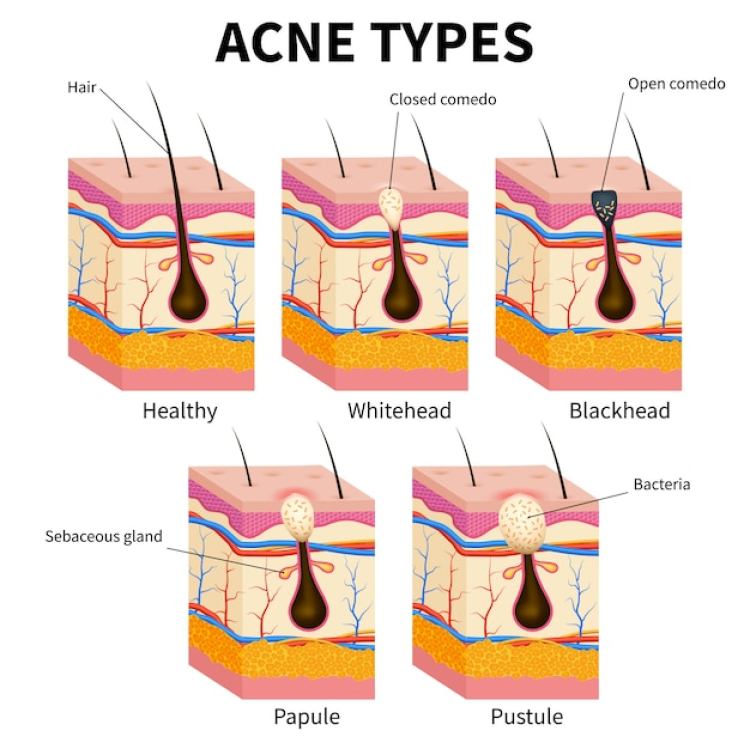 hormonal closed comedones