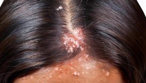 scalp psoriasis pictures showing red patches and white scales