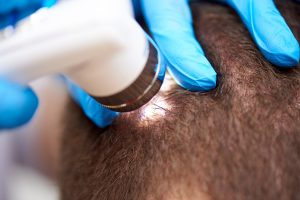 psoriasis scalp treatment