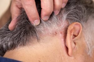 is scalp psoriasis curable