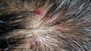 mild scalp psoriasis