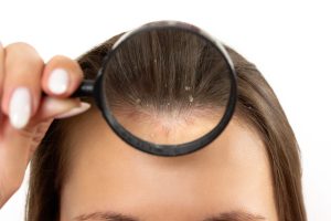 scalp eczema vs psoriasis
